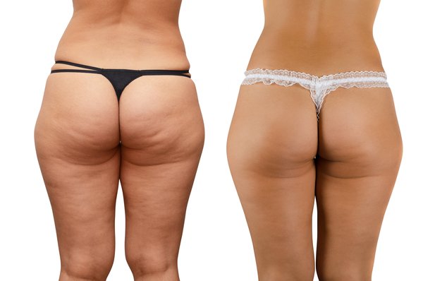 Vor/Nachher-Vergleich von Cellulite