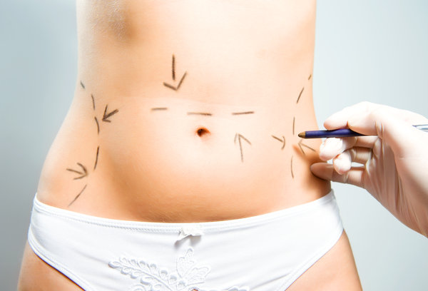 Markierungen am Körper für die Fettabsaugung